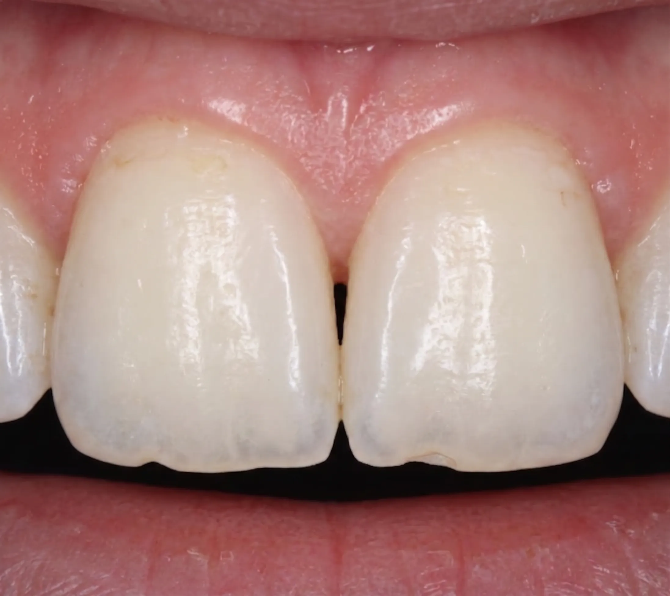 Before treatment