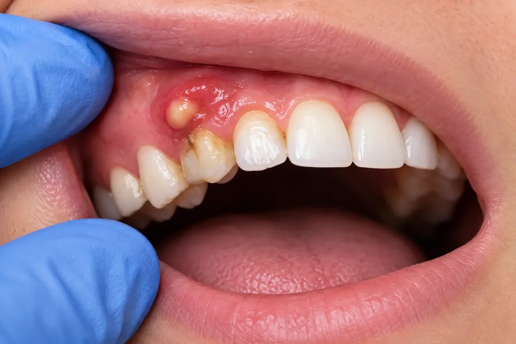 signs of tooth infection